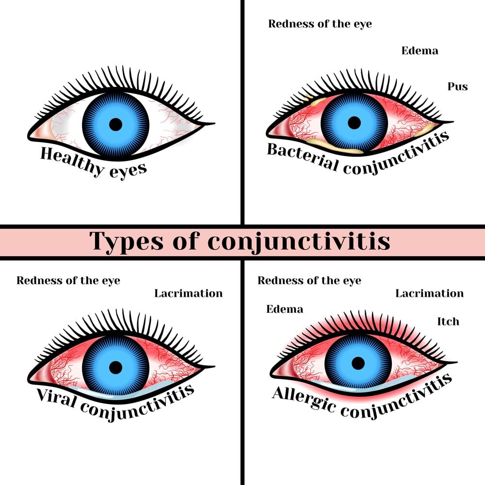 Conjunctivitis   New Jersey Eye Center